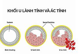 Khối U Lành Tính Trong Tiếng Anh